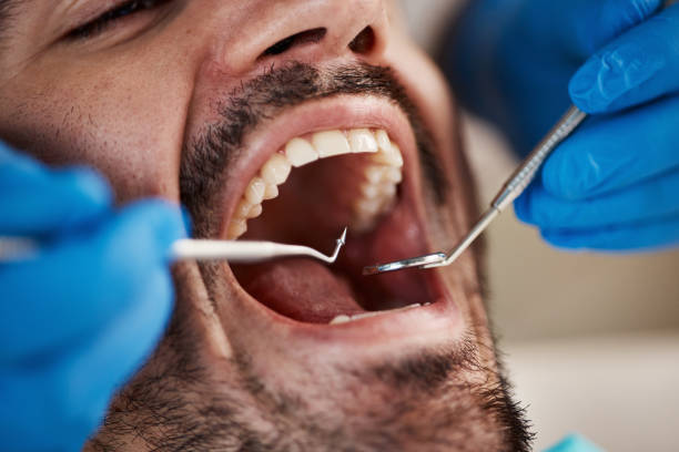Best Emergency Root Canal Treatment in Highland, IL