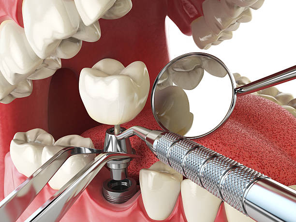 Best Emergency Dentist for Lost Fillings or Crowns in Highland, IL
